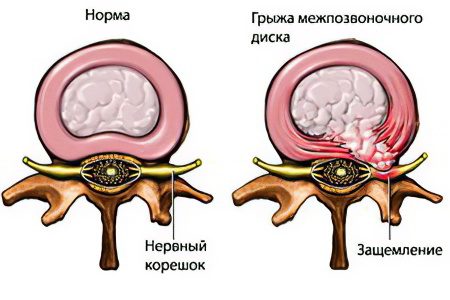 Грыжа межпозвонкового диска